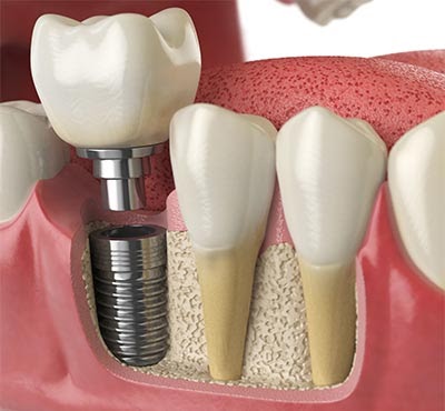 Dental Implants