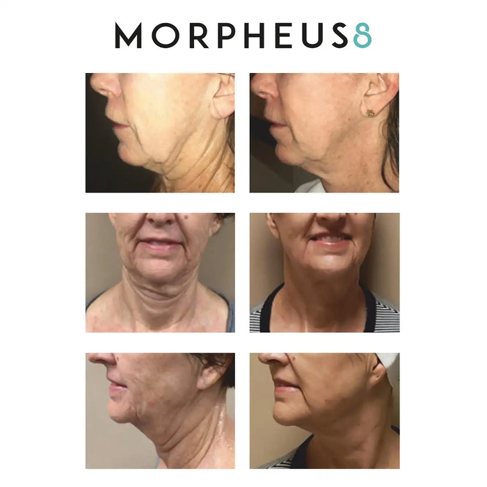 Morpheus8 for face and body