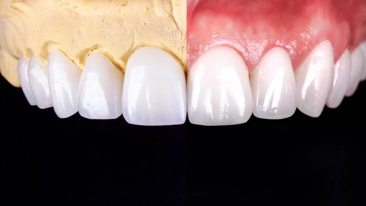 Emax Veneers