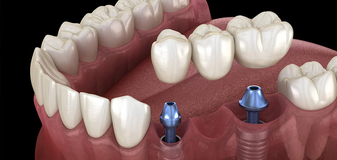 Dental Implants