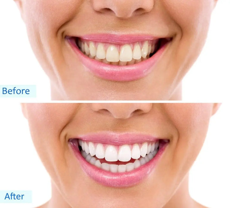 Zoom Teeth Whitening